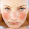 راهکارهای ساده در درمان قرمزی پوست صورت