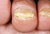 درمان قارچ ناخن پا چیست؟
