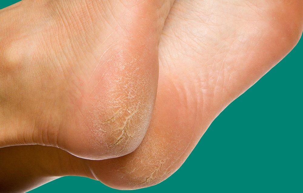 علت ترک خوردن پاشنه پاها چیست؟